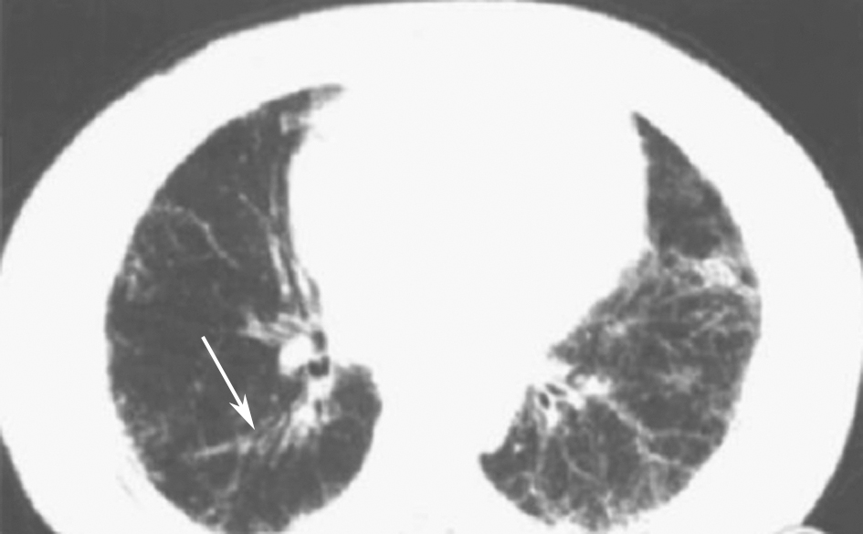图3 干燥综合征胸部CT表现.jpg